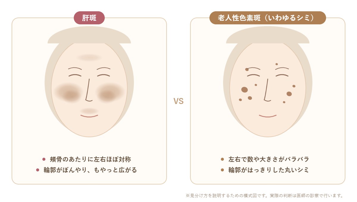 シミと肝斑の違い|肝斑は頬骨のあたりに左右対称に広がり、老人性色素斑は輪郭のはっきりしたシミが左右バラバラに出る模式図