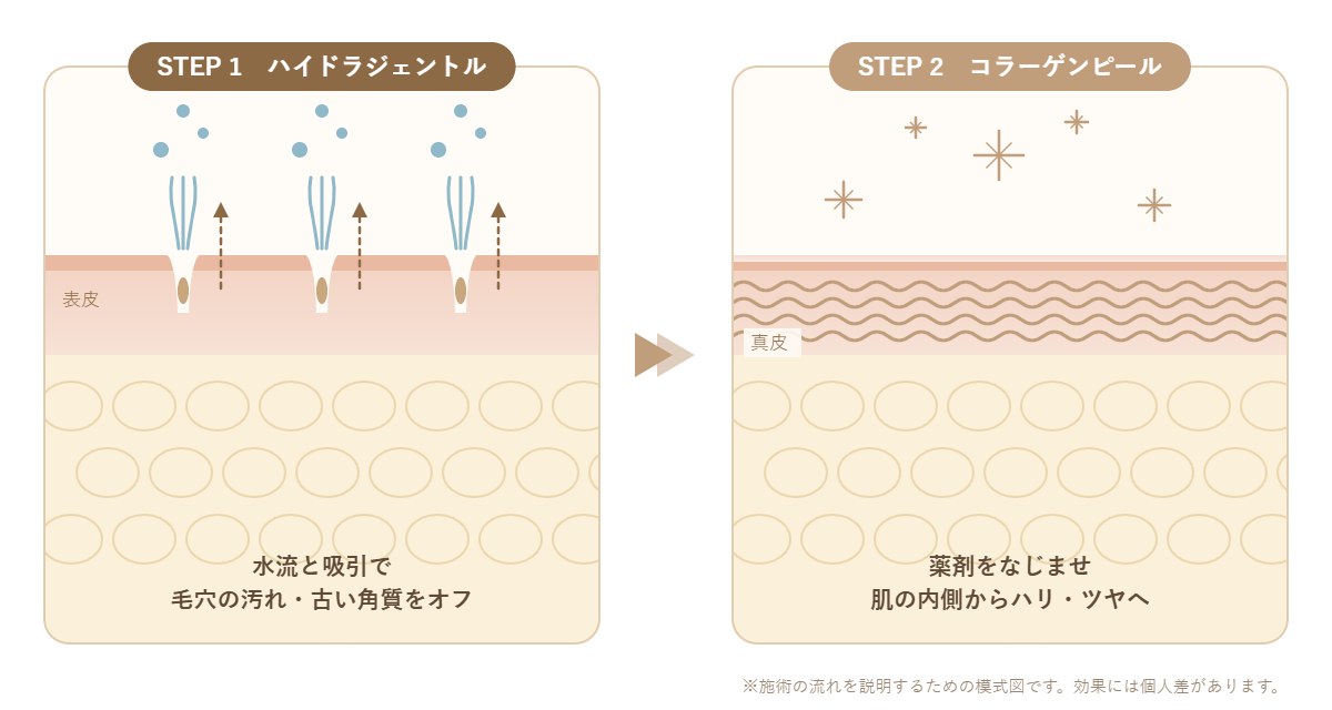 ストロボフェイシャルの流れ|ハイドラジェントルで毛穴を洗浄し、コラーゲンピールでハリ・ツヤにアプローチする模式図