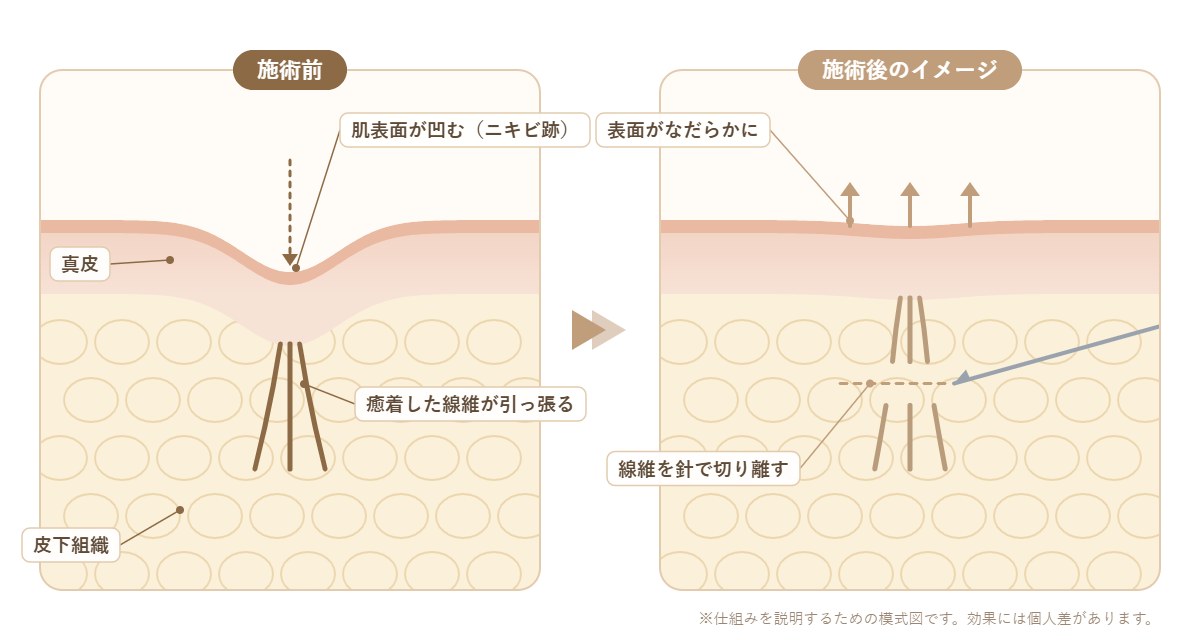 サブシジョンの仕組み|癒着した線維を針で切り離し、凹んだ肌表面をなだらかにする模式図
